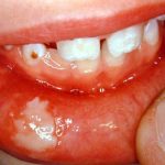 گاز گرفتگي لب، گونه و زبان در كودكان پس از انجام بي حسي برای درمانهای دندانپزشکی