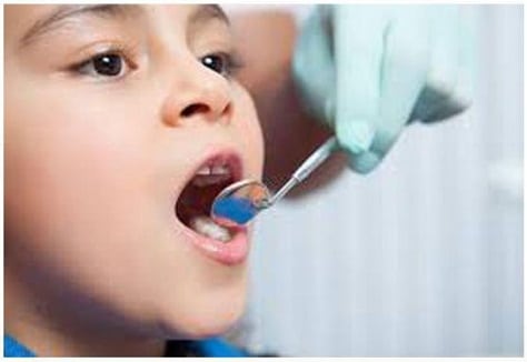 کشیدن دندان کودک